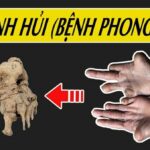 Bệnh phong là gì